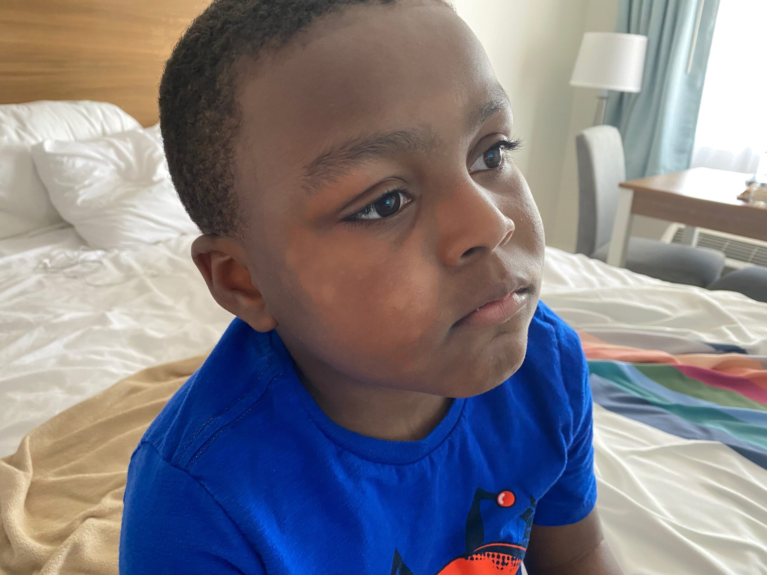 What Are The Lighter Or White Spots On My Black Childs Face